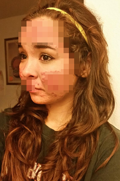 Бывшая наркоманка с навязчивой манией ковырять себе лицо (6 фото)